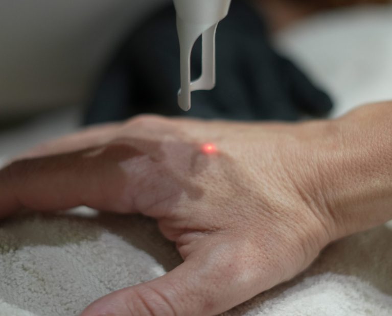 manchas en las manos-envejecimiento-Murcia-Esse clinic